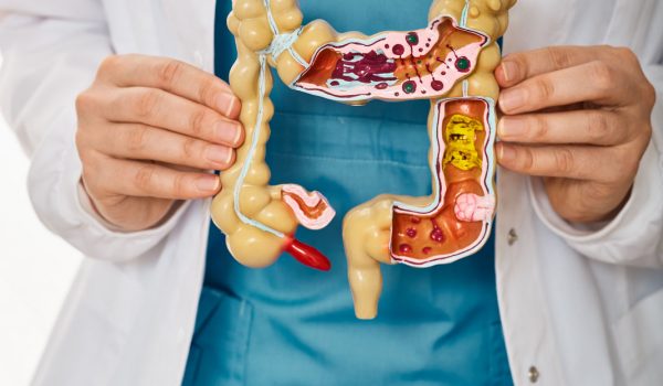 Treatment of colitis, flatulence, indigestion in healthcare. Anatomical intestines model with pathology in doctor hands, close-up